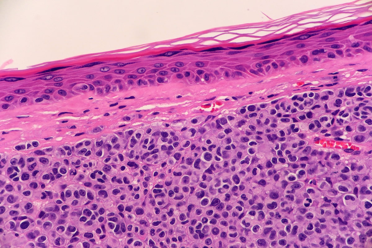What could go right? The made-to-order cancer vaccine