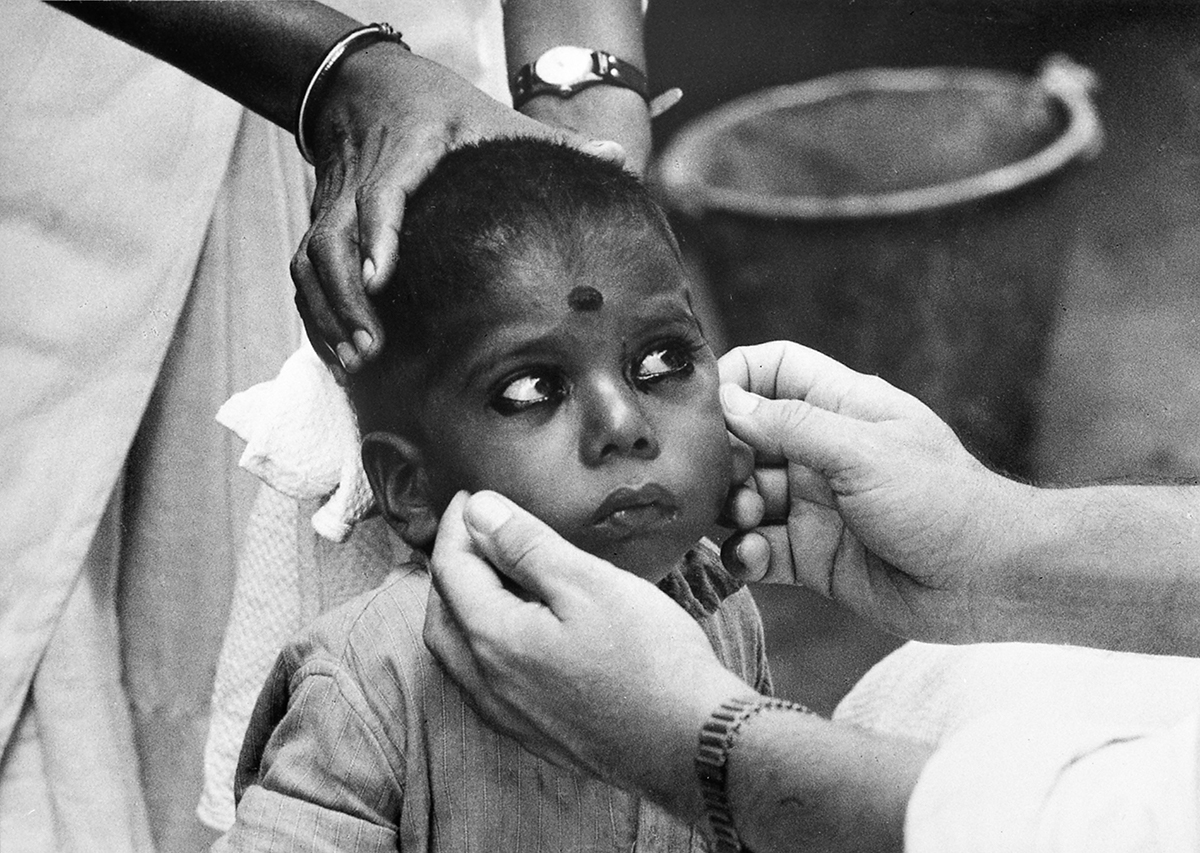 In 1959 it was estimated that nearly 400 million people suffered from trachoma. Though this eye infection does not kill, it can last a lifetime if untreated. Its victims often become blind. In India, trachoma was the largest single cause of preventable blindness. In some rural areas of Northern India the infection rate was as high as 80-90 per cent of the total population. A WHO-assisted pilot project trachoma team based at the Gandhi Eye Hospital in Aligarh, Uttar Pradesh, visited the region village by village, examining patients and organizing antibiotic treatment, and carrying out research to determinate the ways in which infection spread. The methods of attack proved effective in preventing blindness but complete control of trachoma and associated bacterial conjunctivitis requires the support of long-term health education and environmental sanitation programmes. The manner of applying eye cosmetics ("kohl") widely in Eastern countries for both woman and children, is suspected to play an important part in spreading eye infections. A mother with infected eyes can easily pass on the infection to her children, or from one infected child to another, while applying cosmetics to her eyes or those of her children with the same finger or "pencil". Image: WHO / Homer Page